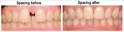 spacing-before-after-invisalign