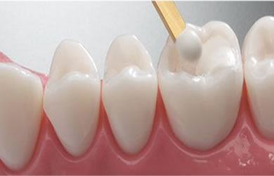 Dental Fillings At Maxident Clinic