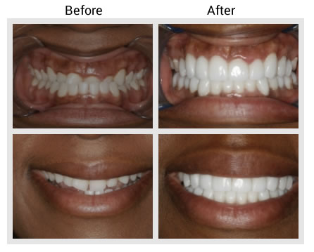 Porcelain Veneers Before and After Treatments