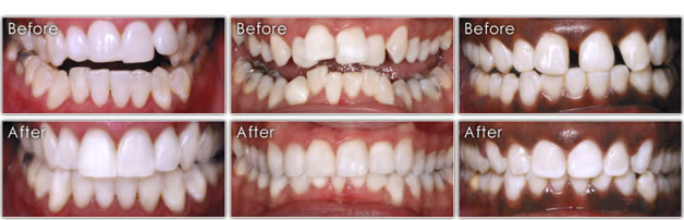 Six Month Smiles Before And After