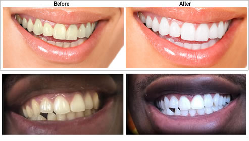 Teeth Whitening-before-after